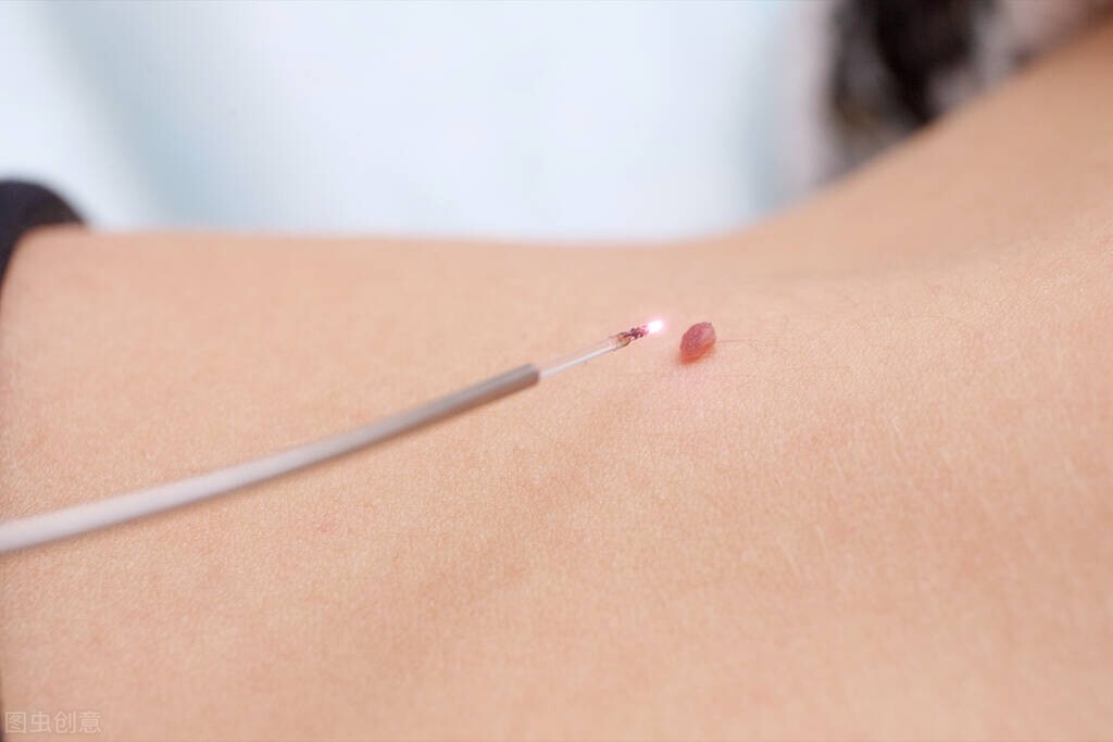 脖子上的小肉粒能揪掉吗,脖子上长的小肉粒可以揪掉吗