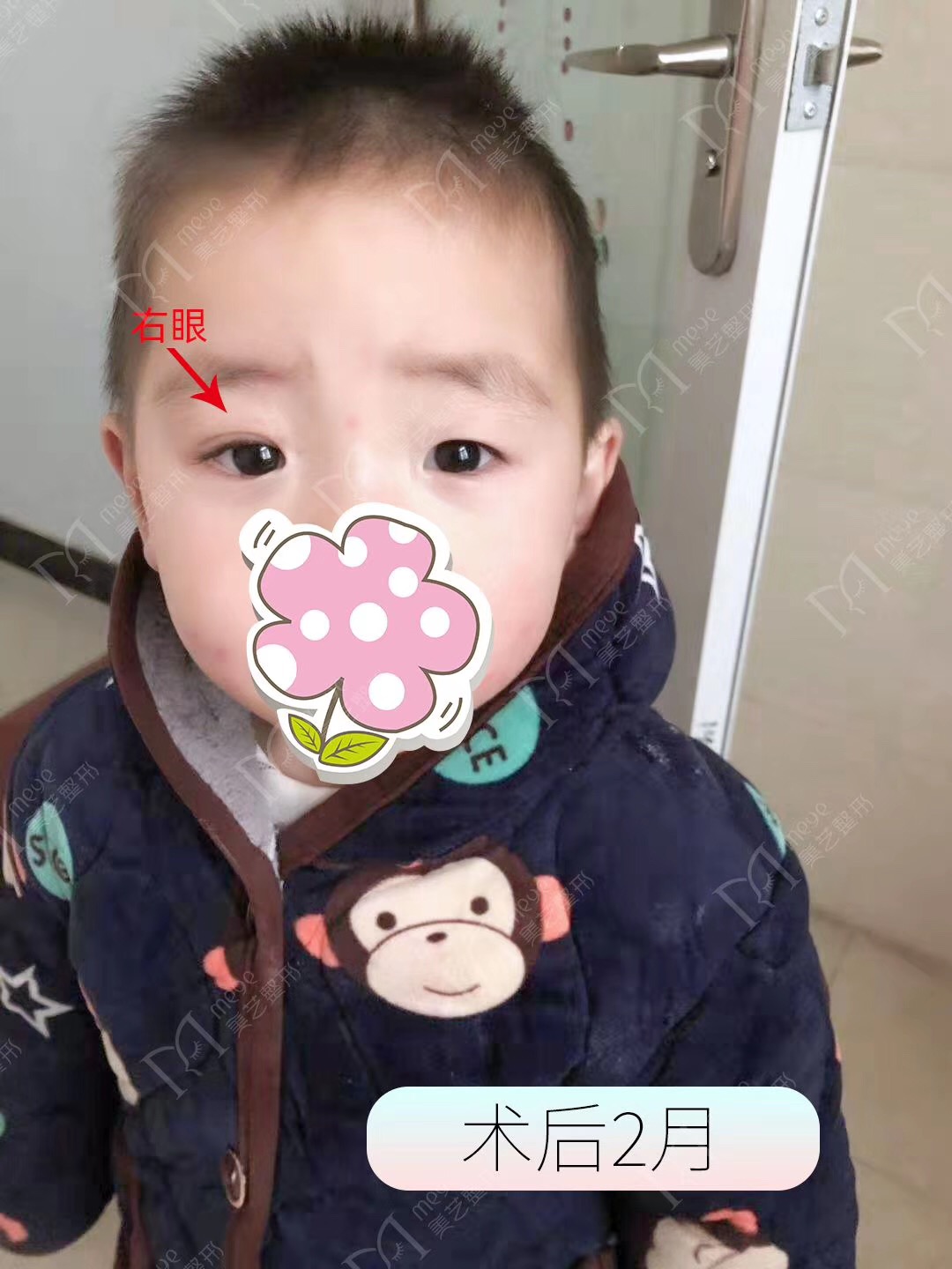 眼睛一大一小的解决方法,眼睛一大一小严重怎么办