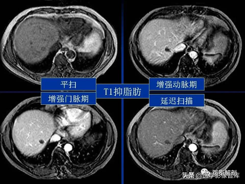 肝炎性假瘤鉴别诊断,肝炎性假瘤影像学表现