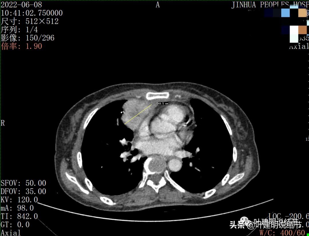 这位老乡，乏力来查，查出这么大个的纵隔肿瘤！会是什么呢？