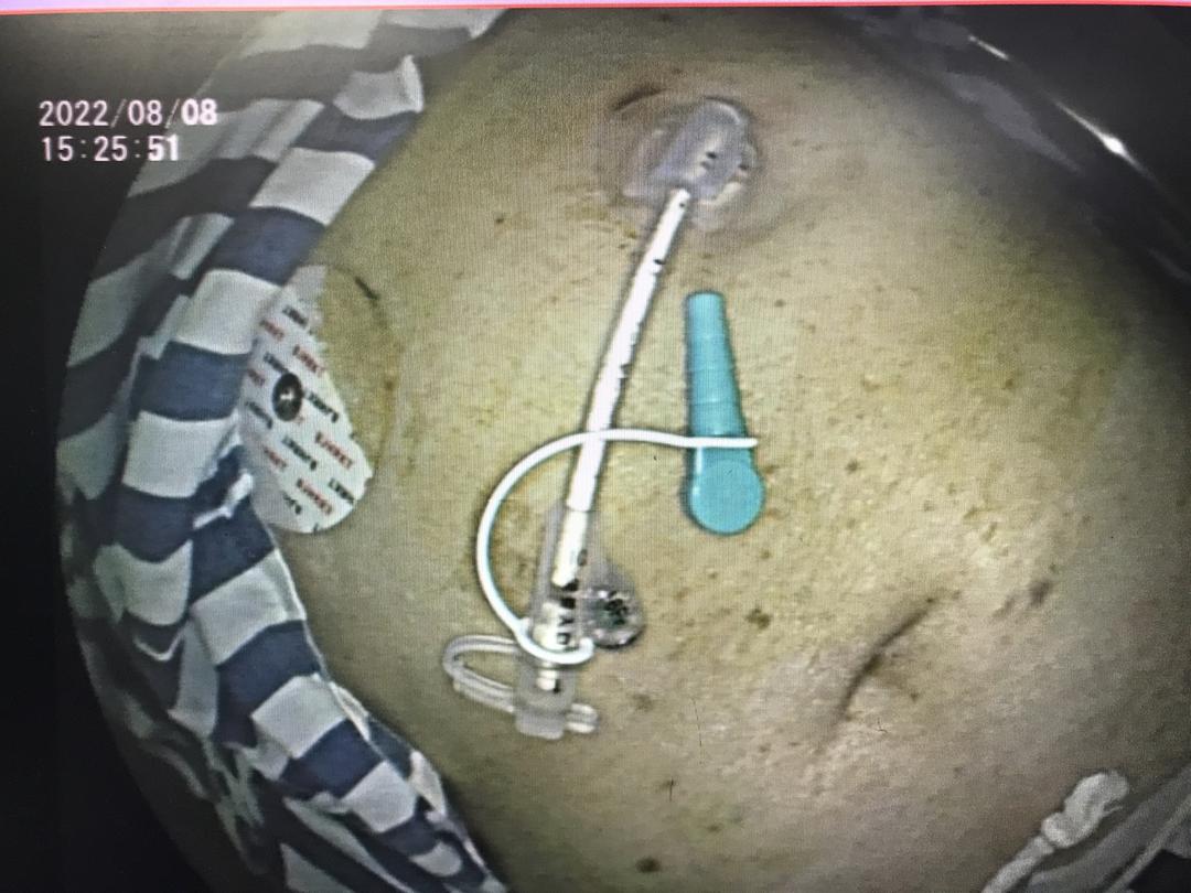 优秀!重庆两江新区中医院年度十佳技术出炉!