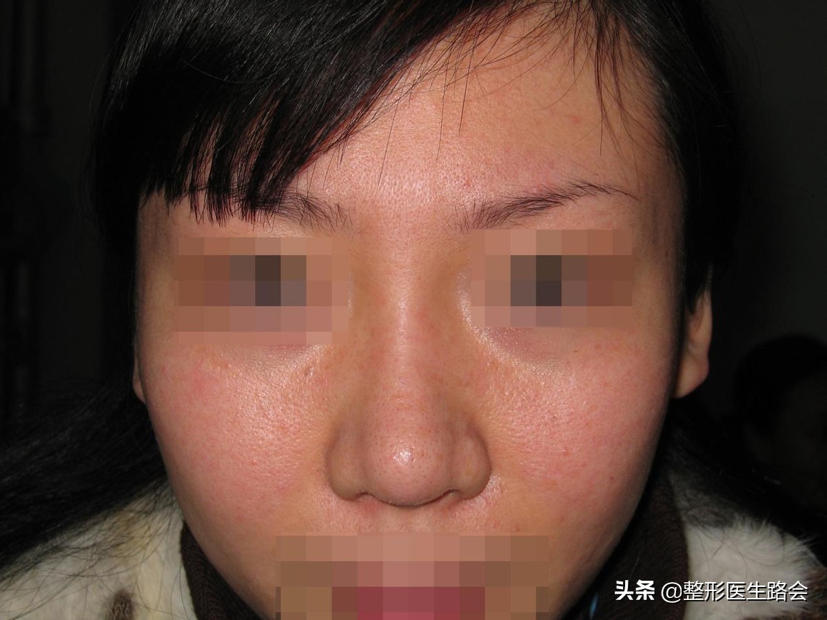 硅胶隆鼻5年歪了怎么修复,隆鼻10天歪了可以矫正吗