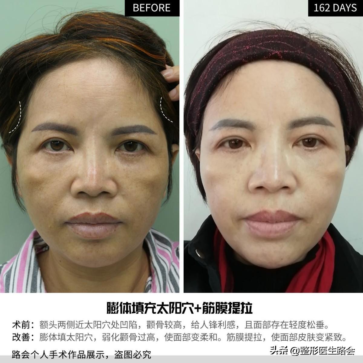 面部暗沉无光泽显老怎么改善,皮肤暗沉皱纹显老