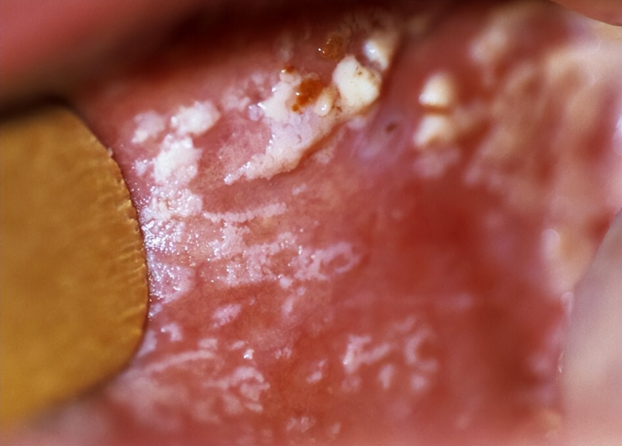 艾滋病后悔药价格,艾滋病后悔