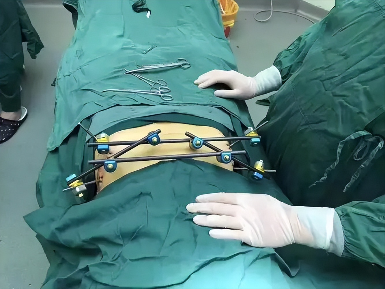 骨盆后环损伤后，新型螺钉的不同内固方法各有何优势？哪种方法好