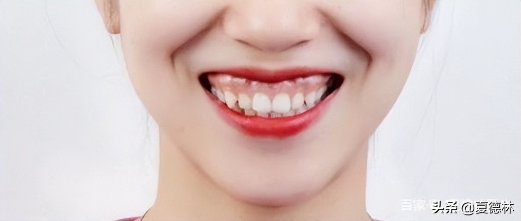笑露牙龈怎么通过日常改善,为什么有些人笑起来露牙龈