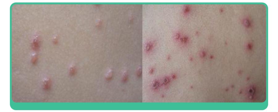 水痘疫苗哪个季节打合适,水痘高发的秘诀