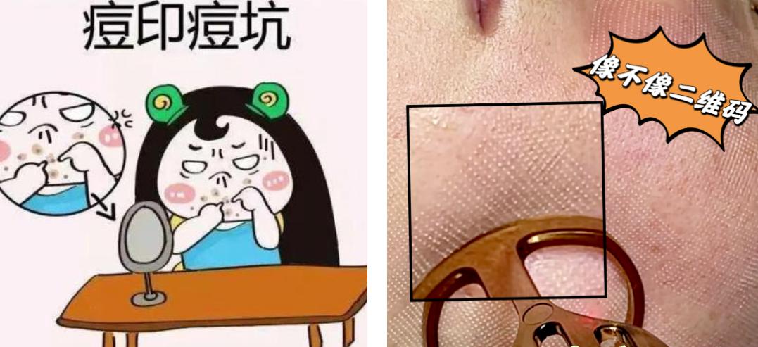 青春痘逆袭的方法,16岁青春期学生痘印如何改善