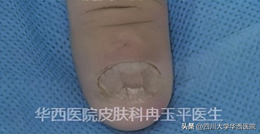 灰指甲是指甲发灰吗,指甲灰色就是灰指甲吗