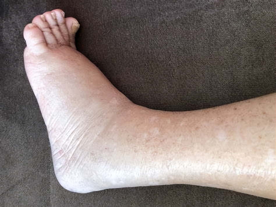 足部手术后肿胀如何处理,足部手术后肿胀发紫怎么消除