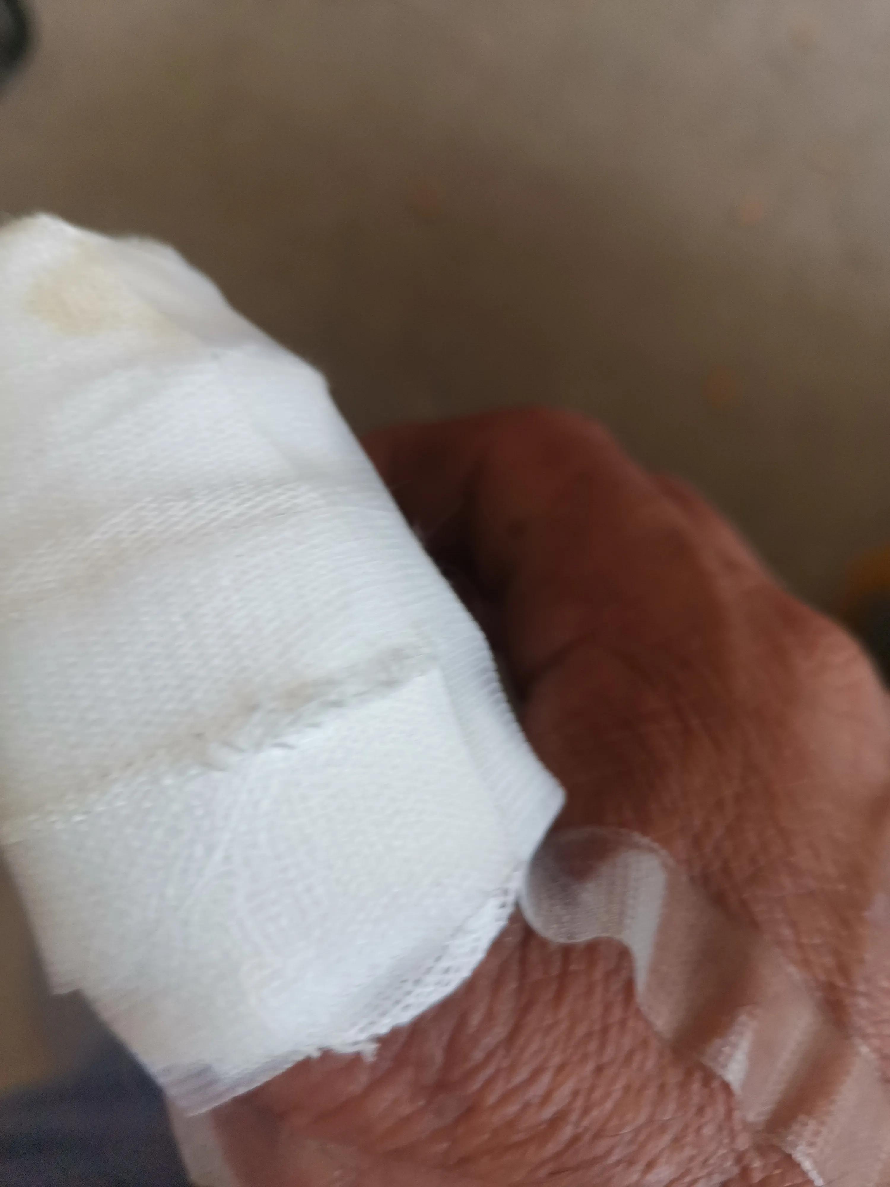 大拇指预防甲沟炎的最佳方法,怎么预防手指化脓