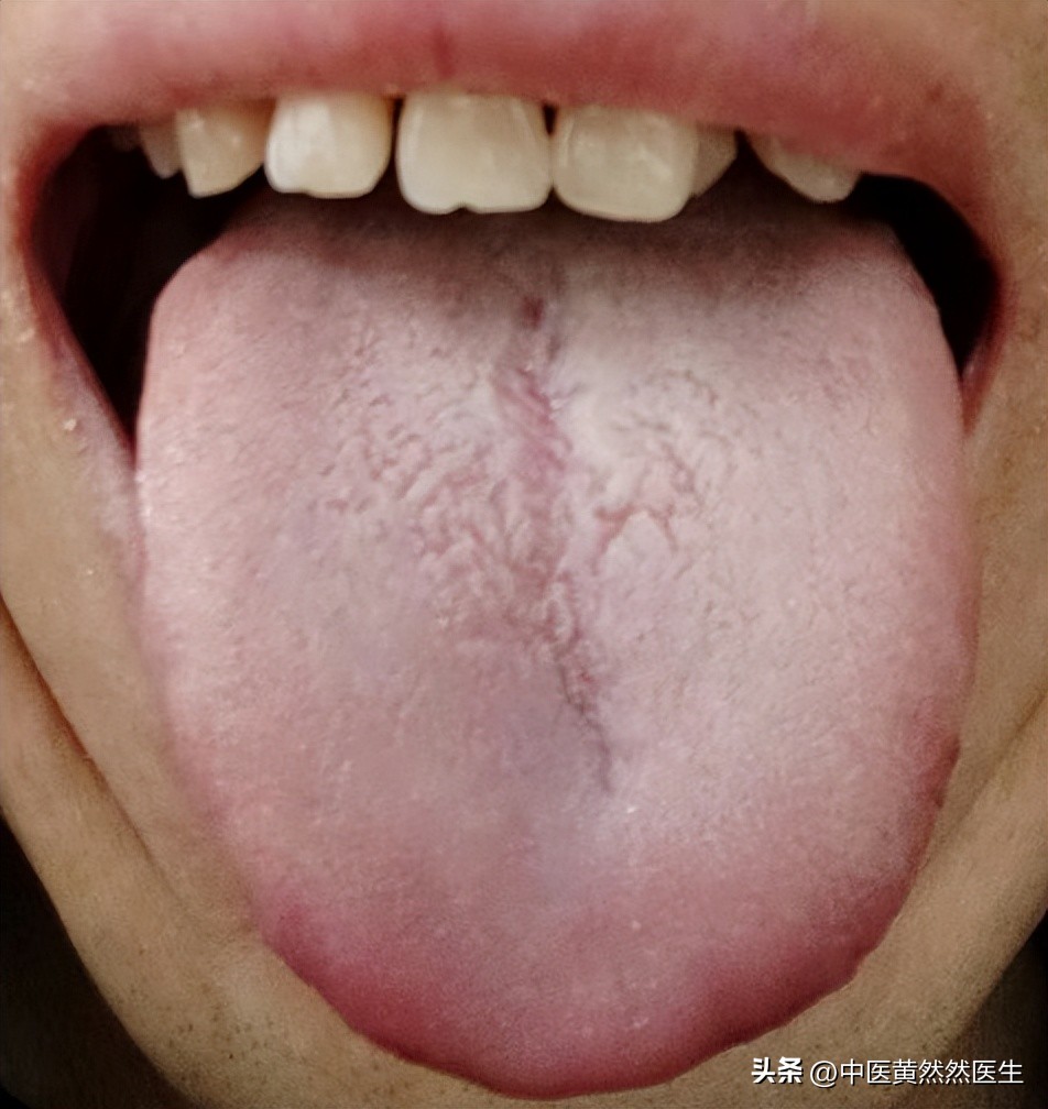 硬度差、中途疲软、阴部瘙痒和这个舌象有什么关系？