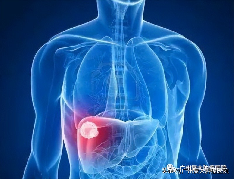 肝肿瘤靠近心脏，微波如何消融？