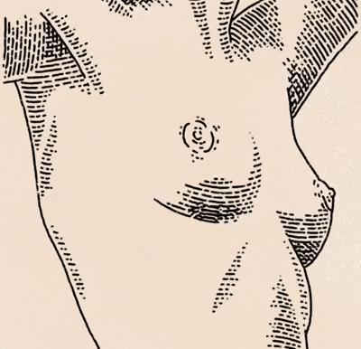 乳头突然变大是什么情况,乳头突然变大疼痛是什么原因