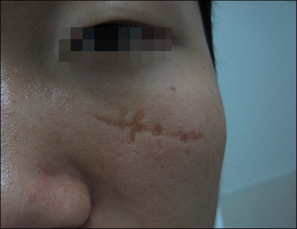 小孩祛疤痕去哪里看,郑州市第二中医院膏药多久去掉