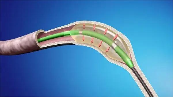 什么原因会导致输尿管狭窄,输尿管狭窄导致什么后果