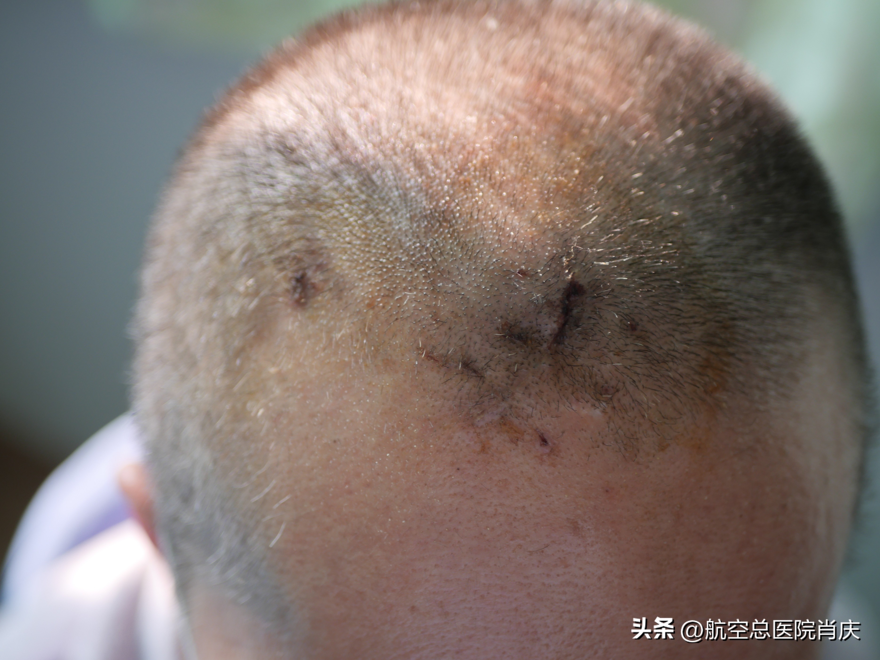 脑积水神经内镜微创是怎么回事,软性神经内镜治脑积水费用