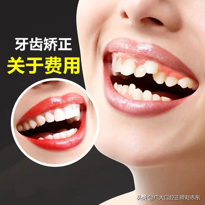 正畸需要多少钱,正畸的费用包含哪些