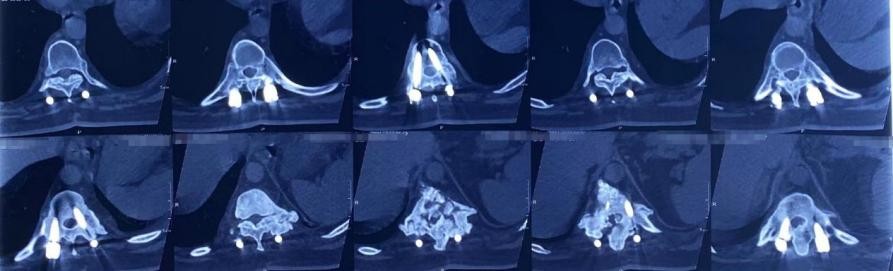 强直性脊柱炎骨折自愈,强直性脊柱炎骨折能恢复好吗