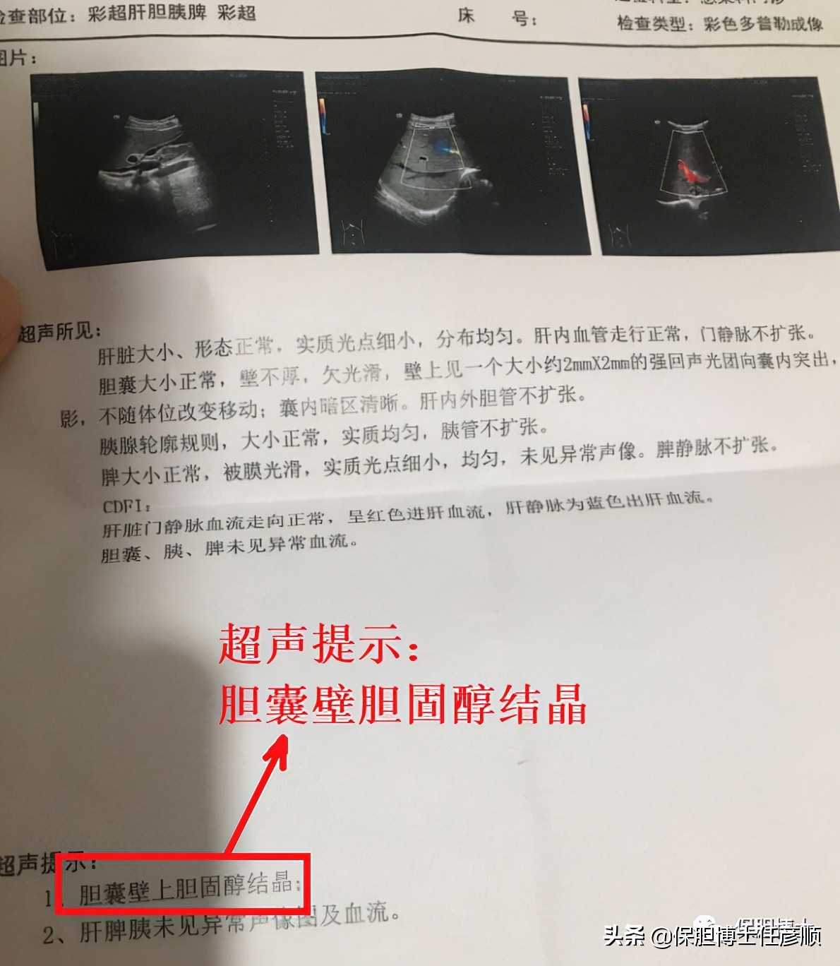 胆囊壁胆固醇结晶能不能喝蛋白粉,什么是胆囊壁胆固醇沉积