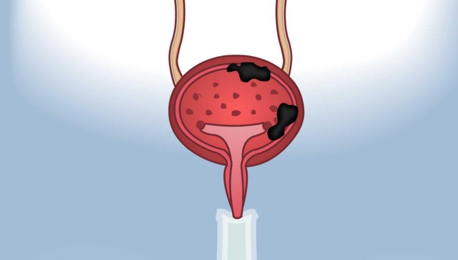 为啥有人一喝水就有尿,为什么有人一喝水就排尿