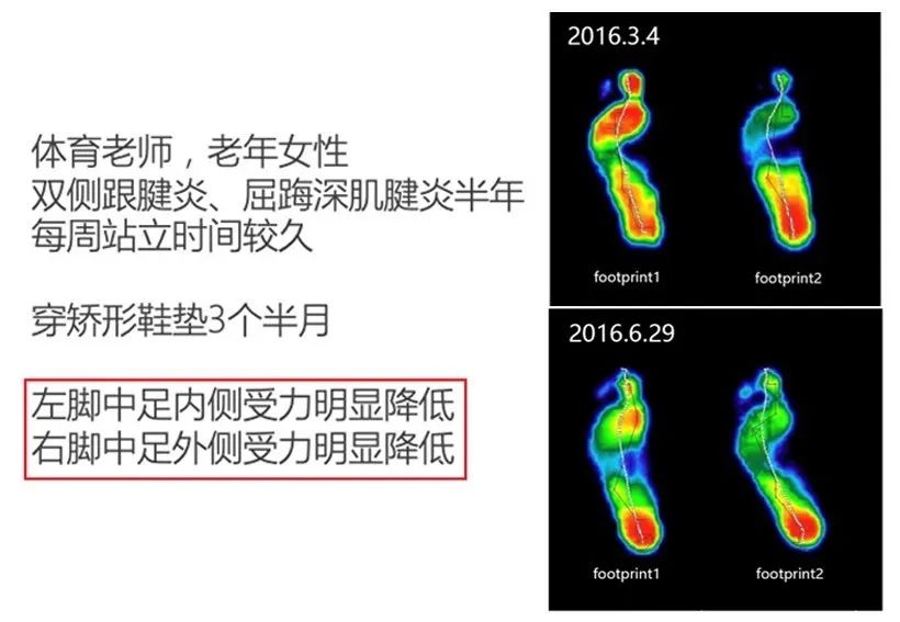 足弓消失的扁平足,改善足弓塌陷跪姿双脚要不要并拢