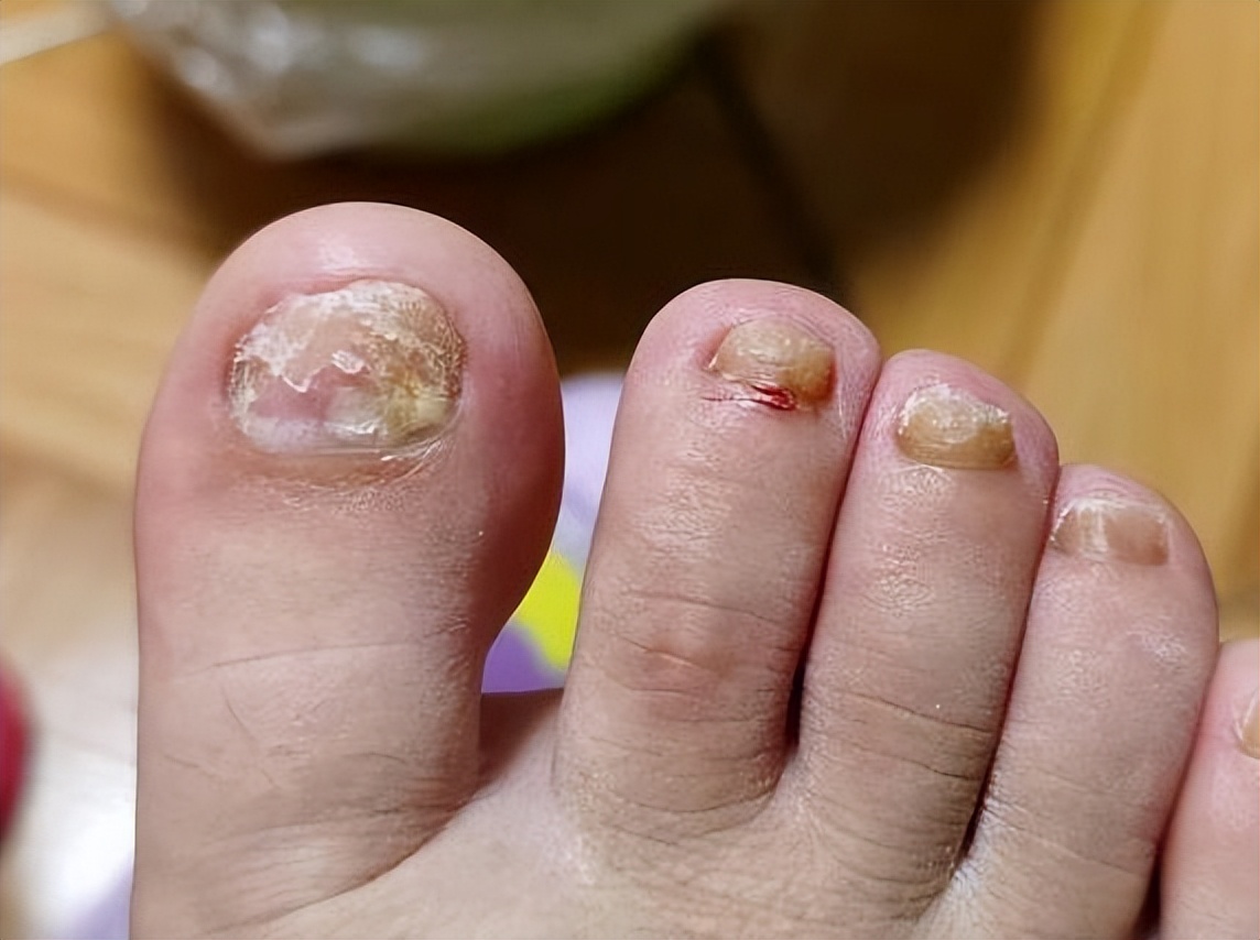 三招断根灰指甲,藿香正气水可以祛除灰指甲吗