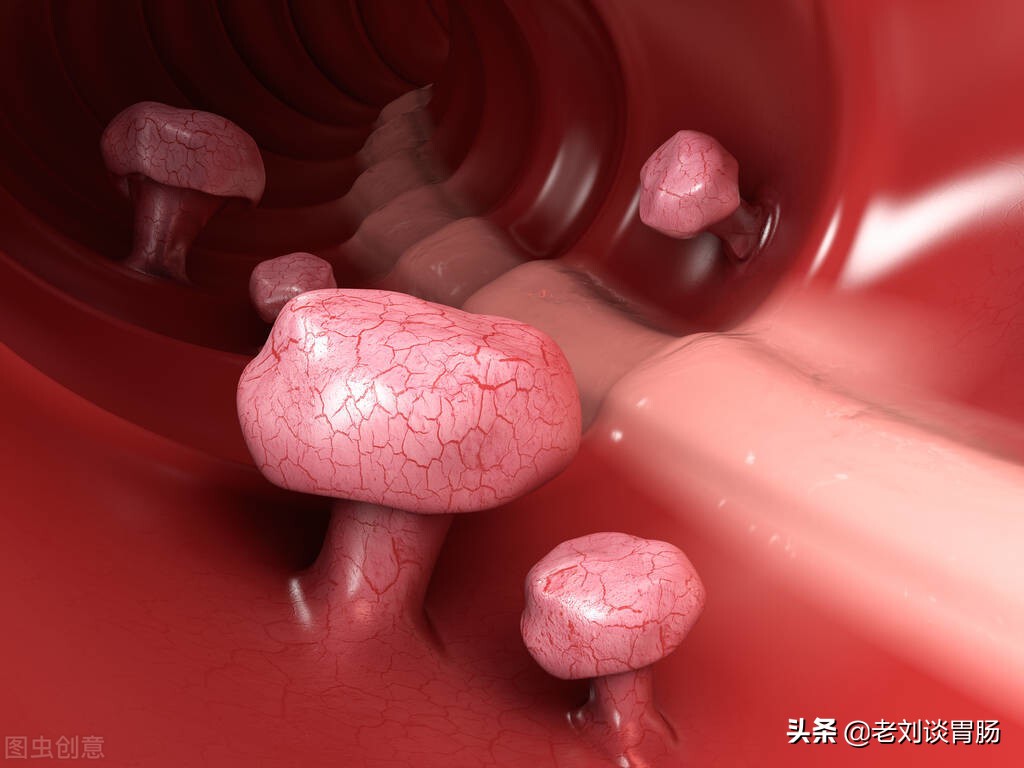 肠镜检查会漏诊肠息肉吗,肠镜检查出息肉怎么治疗