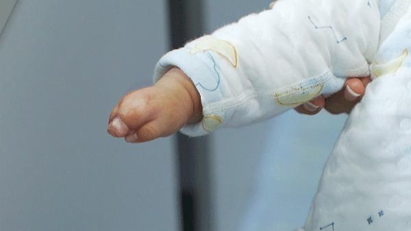 并指切开以后会长好吗,并指可以切开吗