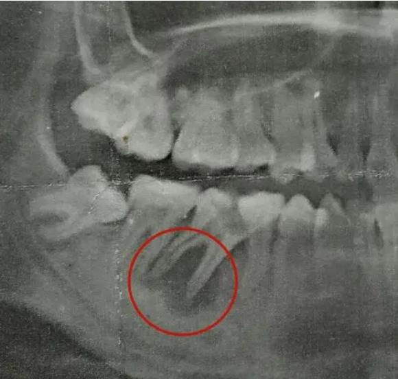 牙根尖炎治愈后要不要做牙套,牙根尖炎一般多久可以康复