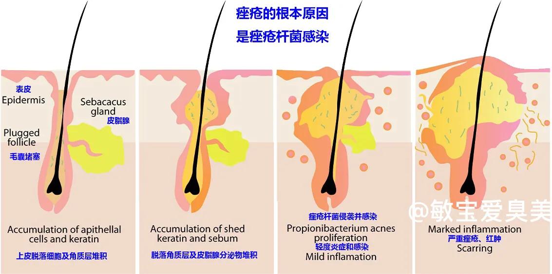 皮肤痘痘粉刺,各种皮肤痘痘问题讲解