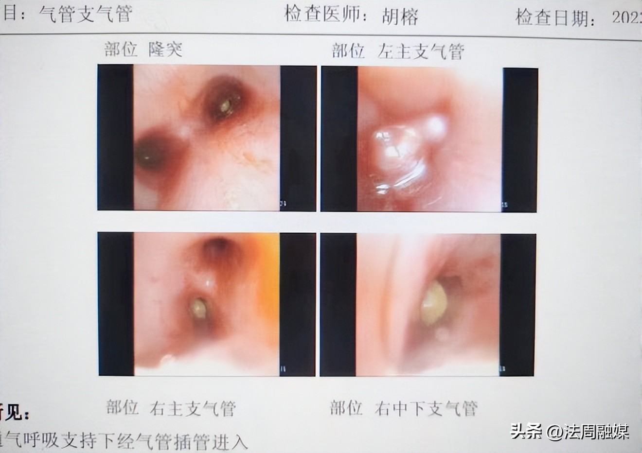儿童吃花生卡气管死亡,小孩去吃坚果卡住医生接力急救
