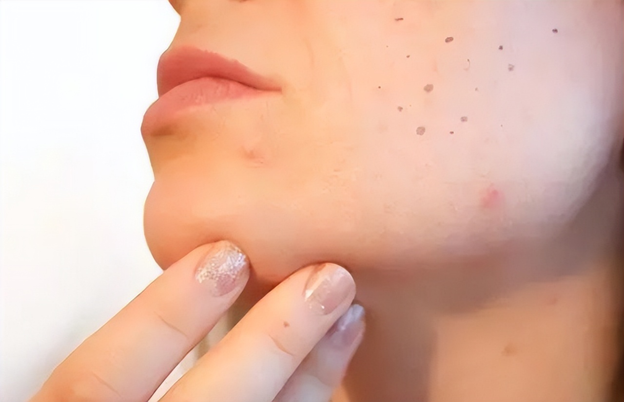 老人长老年斑很痒怎么办,白醋和红霉素软膏能去除老年斑吗