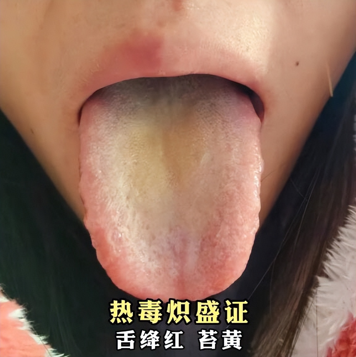 银屑病中医彩色图谱,银屑病舌象分型