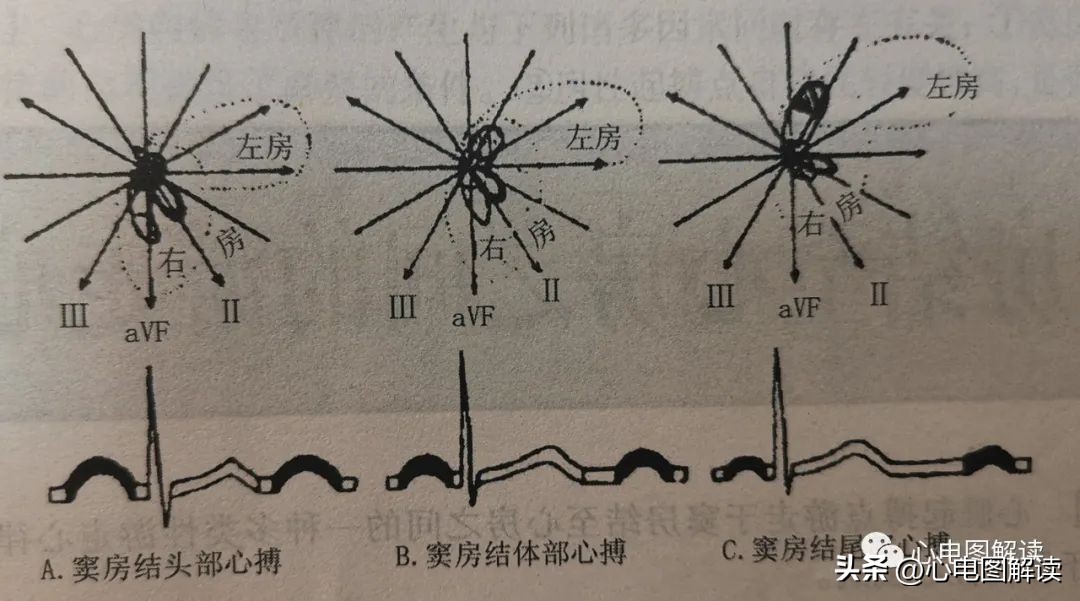 窦房结游走心律的临床意义,窦房结游走心律心电图特征