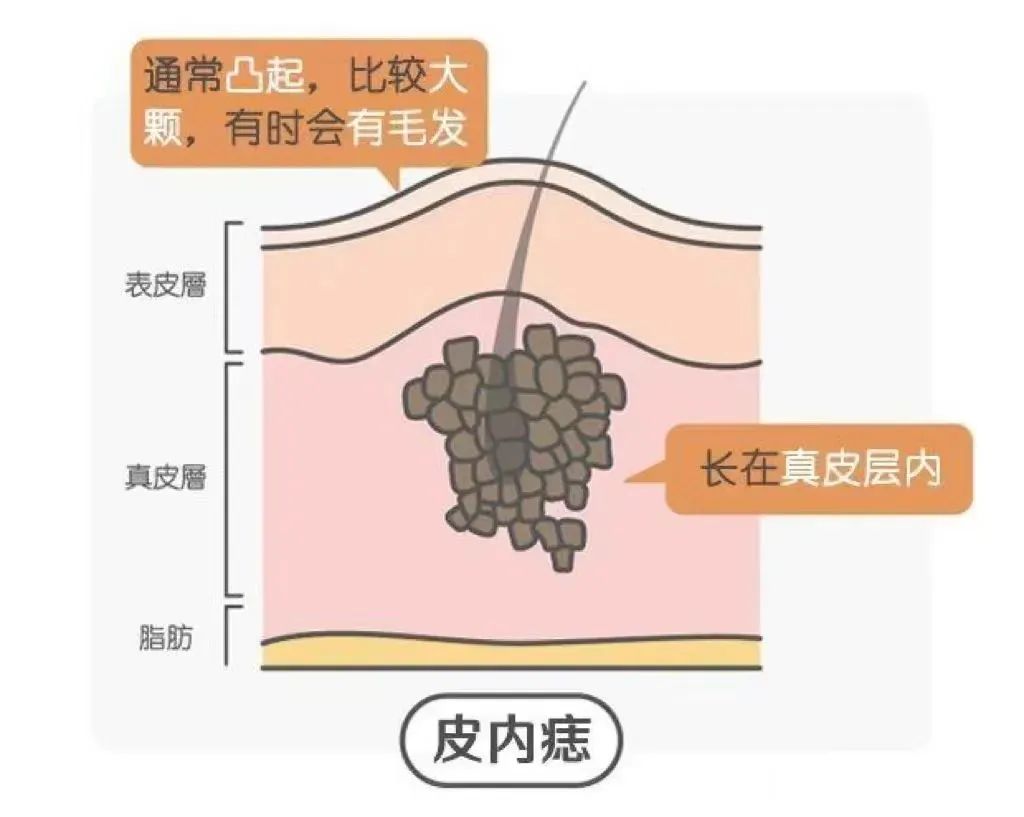 点痣有什么讲究和忌讳,有痣别乱点这两种方法祛痣才靠谱