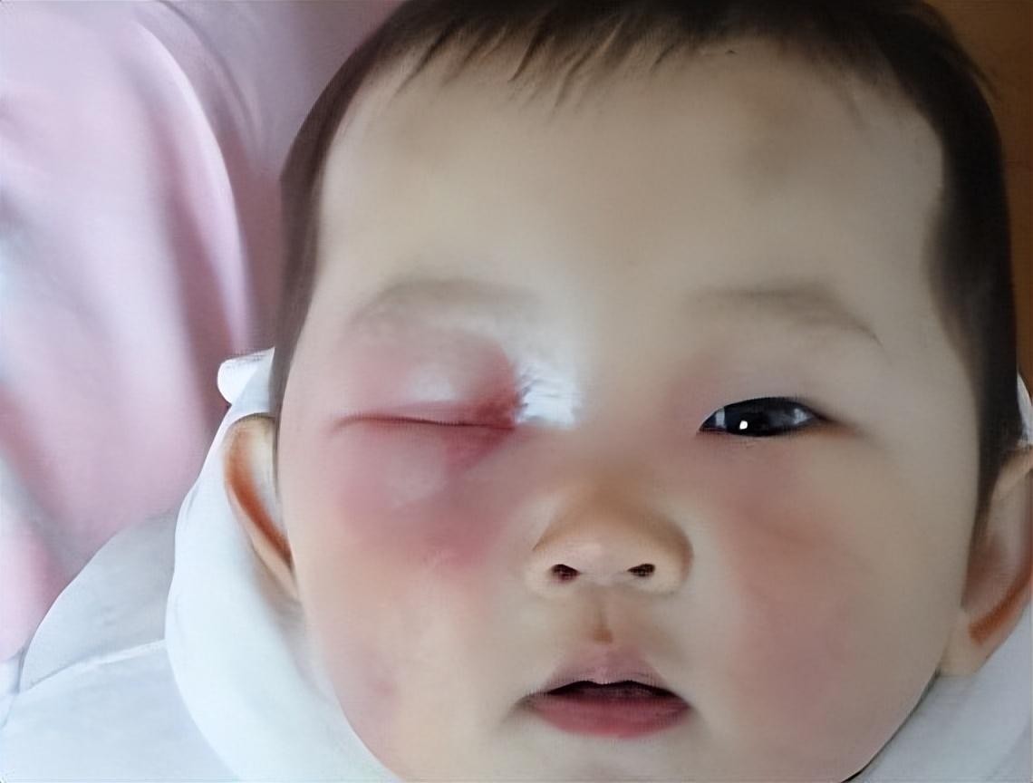 八岁男孩眼球被溶解,20分钟孩子眼球溶化无力回天