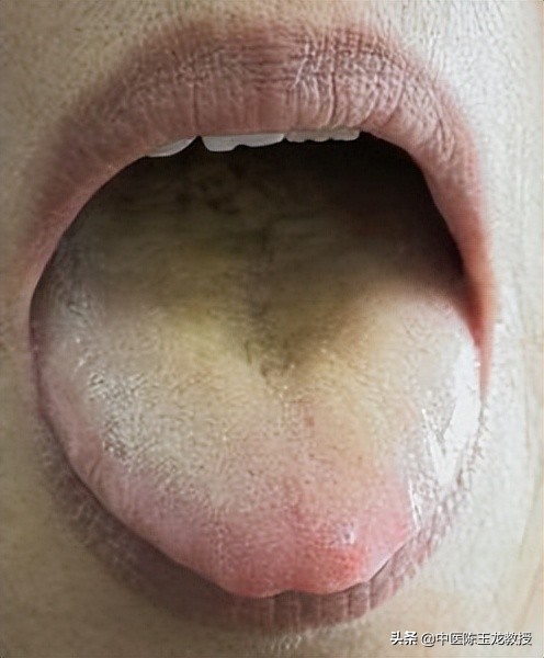 大肠湿热和膀胱湿热吃什么中成药,脾胃湿热和肝胆湿热同治的中成药