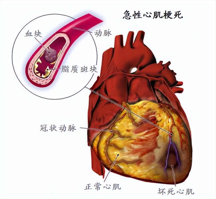 76岁老人心脏房颤是怎么引起的,80多岁老人持续房颤意味着啥
