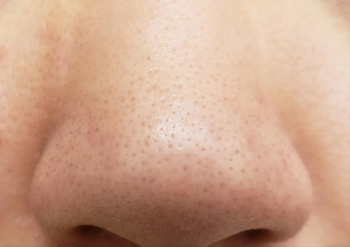 鼻子黑头感觉脏脏的,草莓黑头怎么去除最有效