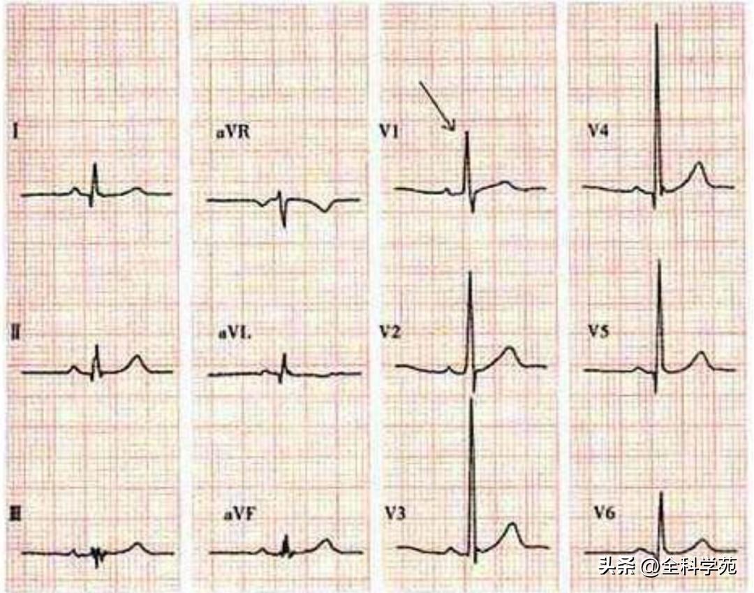 心电图qrs间期变长是怎样造成的,心电图qrs振幅多少是正常范围