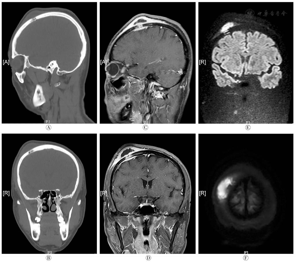 美国土壤和水中惊现类鼻疽病原菌，致死率50%！可怕，人普遍易感