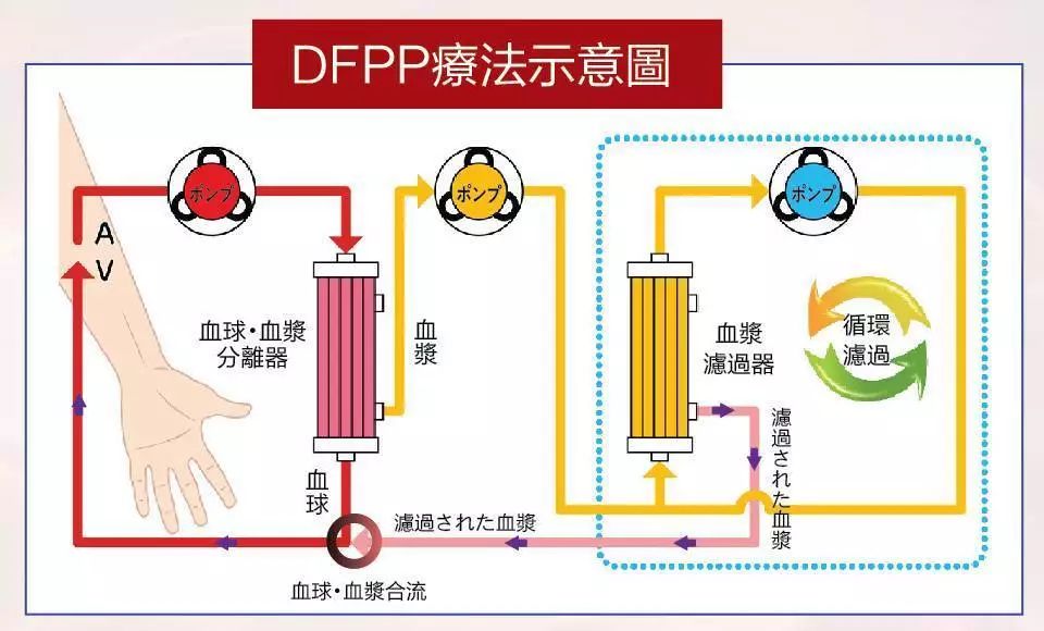 血管“清洁工”DFPP：专治血液不干净