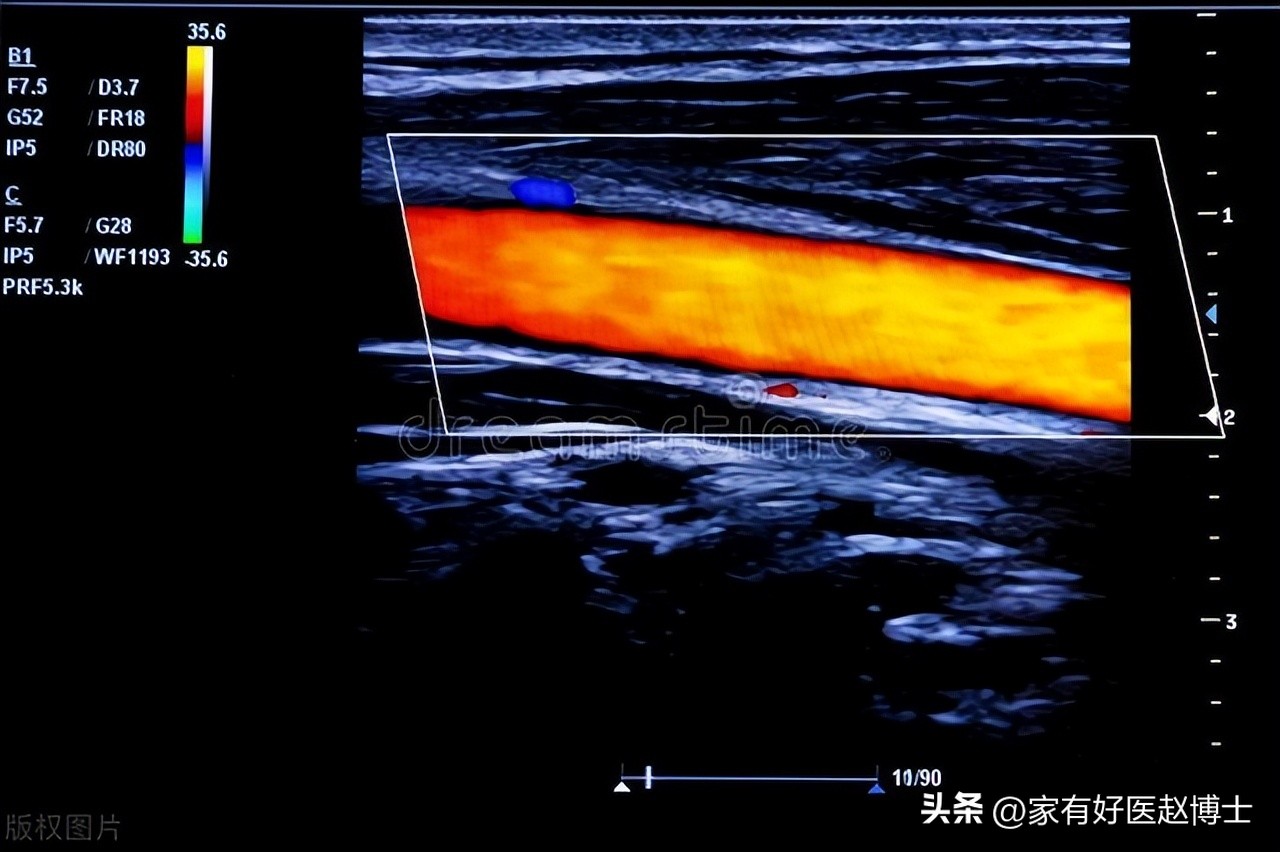 超声颈动脉可以查出什么原因,超声颈动脉斑块的危险评估
