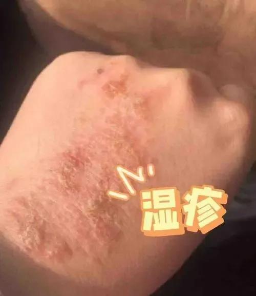 水疱型湿疹中药治疗,湿疹如何治疗发痒裂口