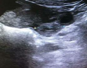 双胞胎隔“宫”相望，医生“攘外安内”