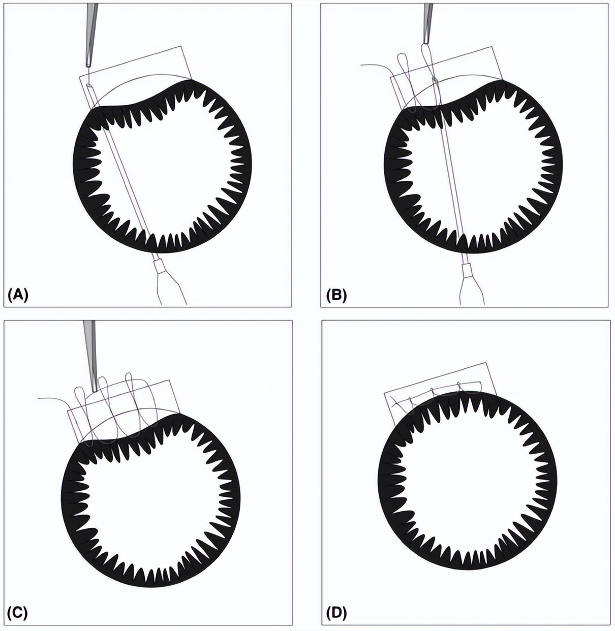 同济大学附属上海东方医院金海鹰教授：巩膜层间缝纫机技术要点