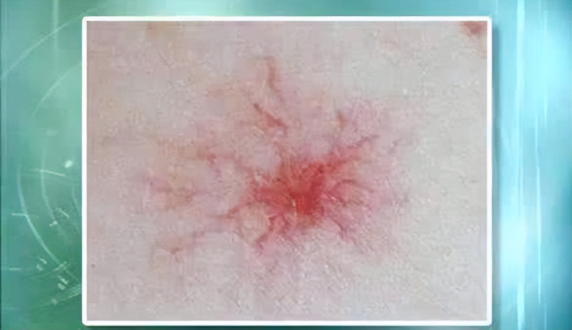 肝癌晚期身上痒是怎么回事,肝癌晚期后背痒是什么原因