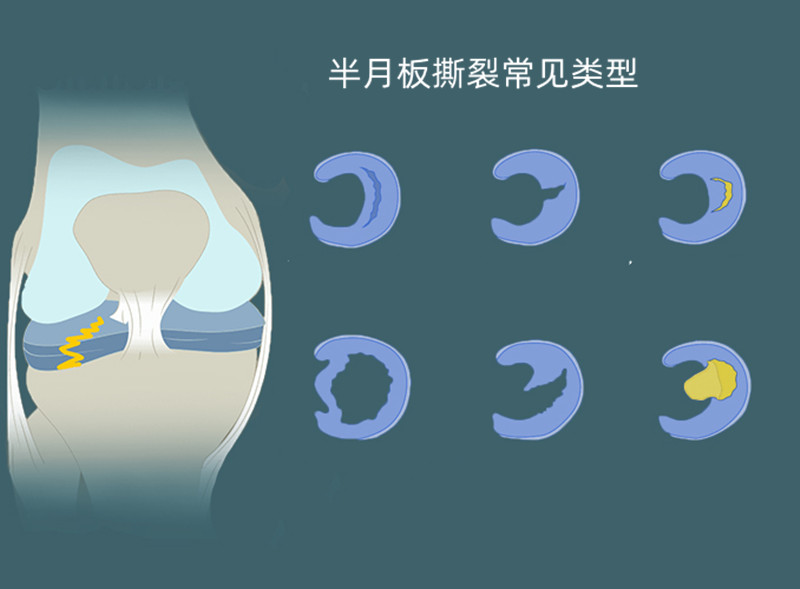 做完膝盖半月板手术一年后嘎吱响,膝关节半月板手术后响是怎么回事