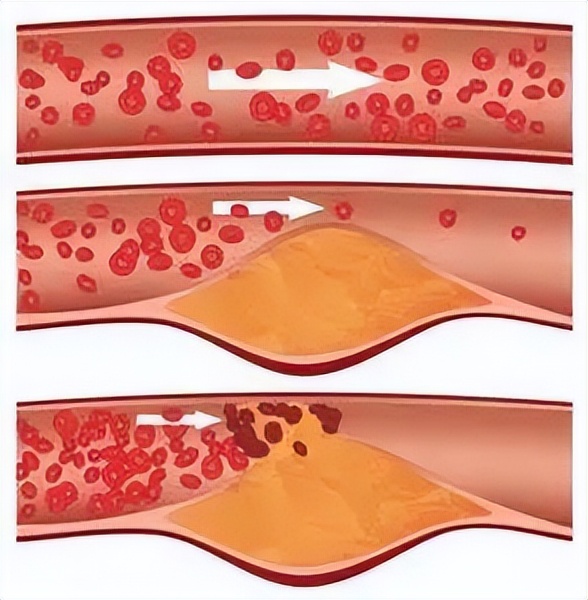这根血管连通大脑最容易堵!很多人半身不遂后才发现!不看后悔!